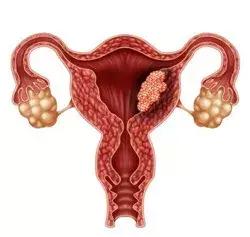 梁雪芳:怕它不来,又怕它乱来!异常子宫出血怎么办?