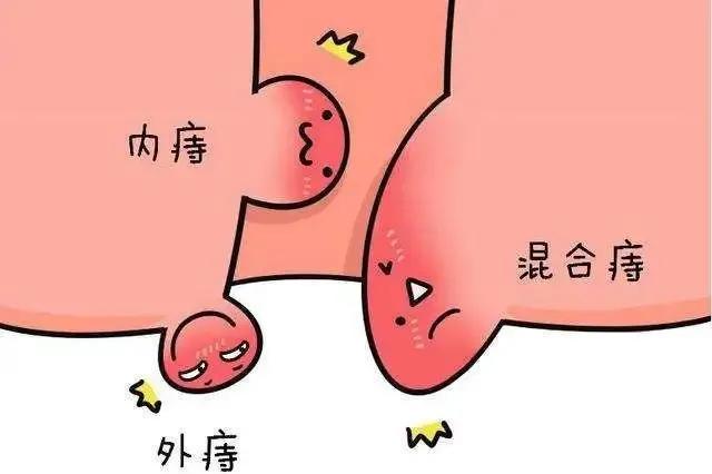 大便排不尽老是肛门堵咋办,肛门神经紧张大便不尽怎么治疗