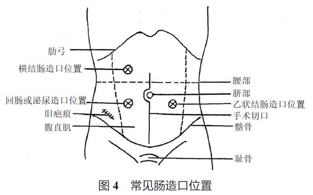 中国结直肠癌诊疗规范(2017年版)