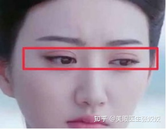 为什么割的双眼皮会显得假,为什么有的双眼皮做出来特别假