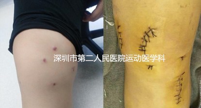 髌骨半脱位关节镜微创手术,髌骨脱位二联手术