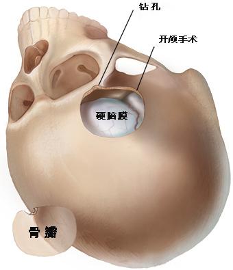 开颅手术经过哪些结构,开颅手术是几类手术