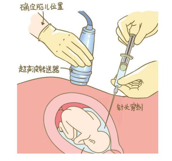 产前风险评估有必要做吗,孕妇产前筛查高危情况有哪些