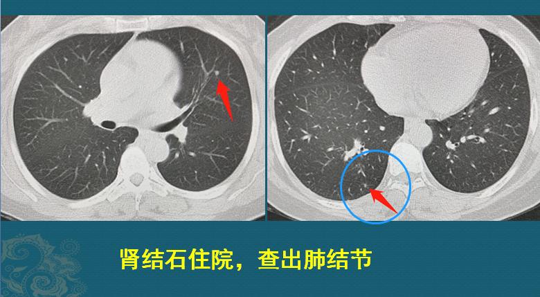 癌细胞增长的速度,癌细胞爆发性扩散