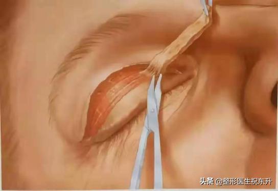 切开法双眼皮,切开双眼皮修复后多久可以再修