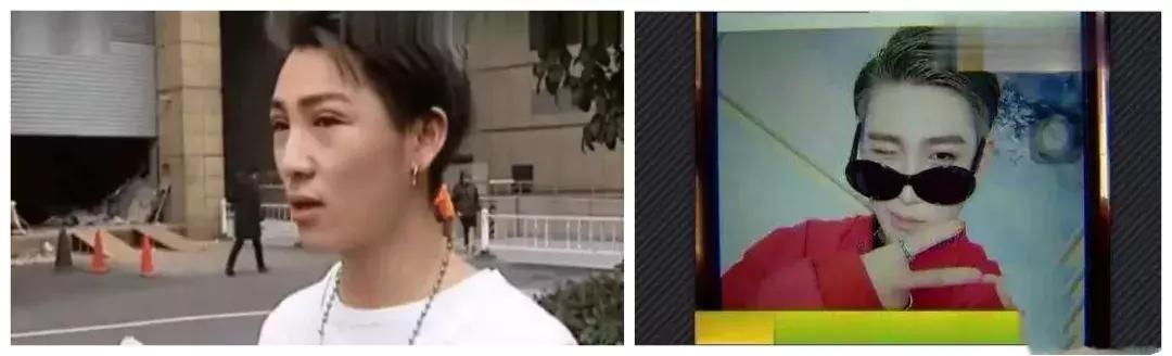 男生割内双眼皮手术,男子去割单眼皮后的结果