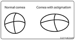 小孩眼睛近视散光怎么改善,眼睛散光近视要怎么改善