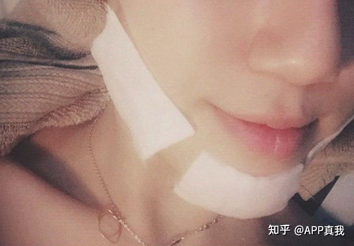 怎么用芦荟胶才能祛痘印,日常生活祛痘印最好的方法是什么