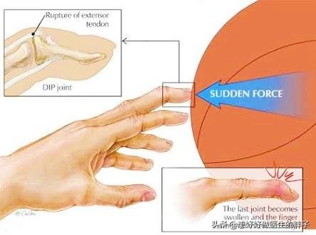 打篮球脚踝扭伤拍片显示没有伤到,打篮球手指挫伤和骨折怎么分辨