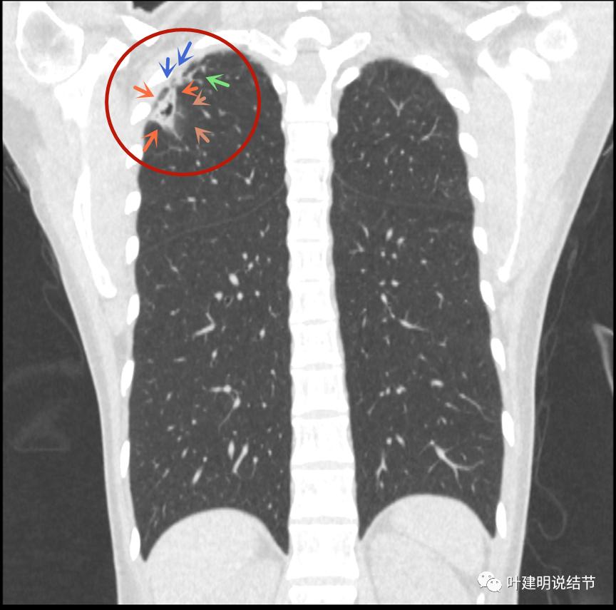 临床诊断孤立性肺结节,空洞型结节一般是什么性质
