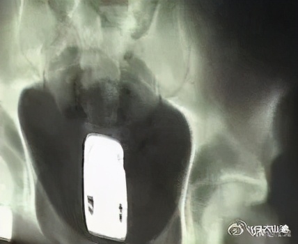 肛肠科医生的手指为什么这么粗,肛肠科医生用手指做检查