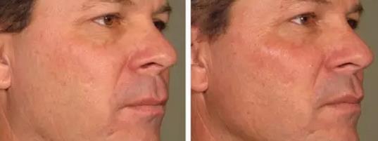 超声刀战胜法令纹原理,超声波祛法令纹有用吗