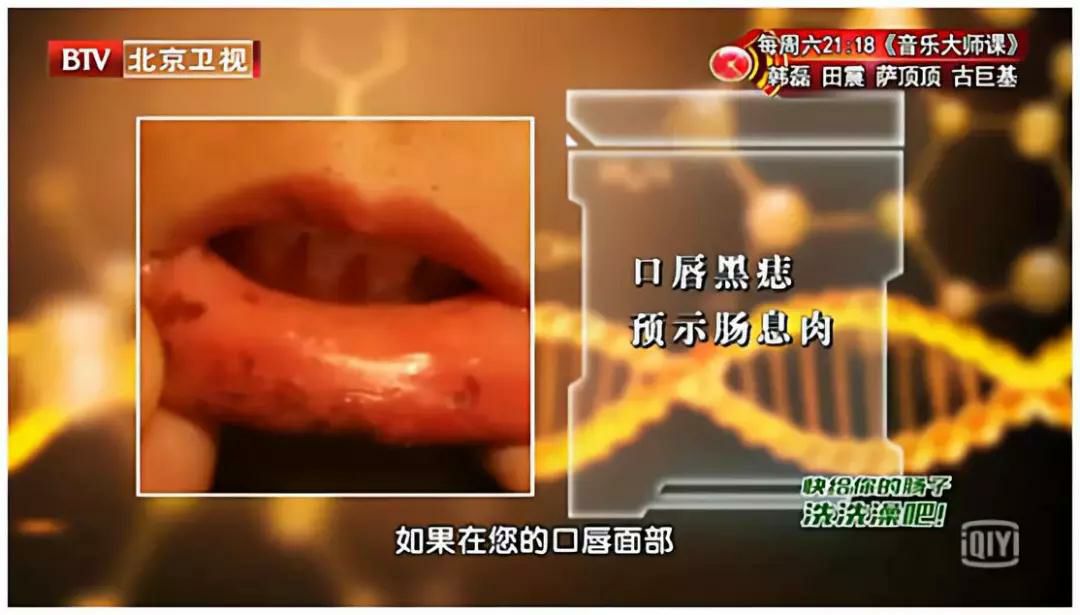 肠癌出现症状往往就是晚期吗,肠癌发现之前有哪些征兆