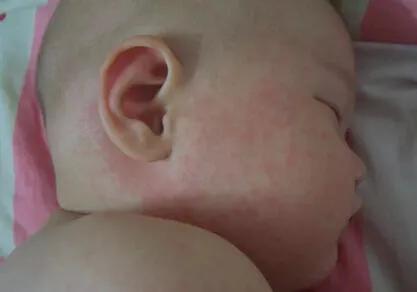 春天,宝宝皮疹的高发期!家长看看怎么辨别皮疹和护理!