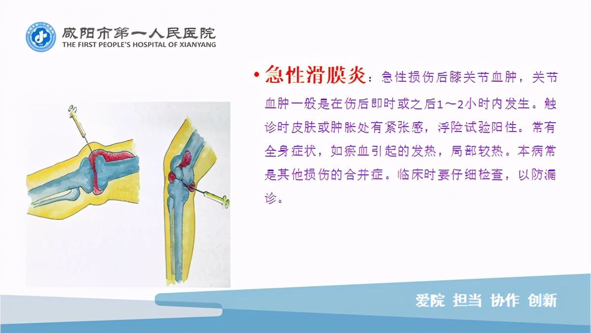 臭氧玻璃酸钠治疗膝关节炎怎么样,膝关节滑膜炎臭氧