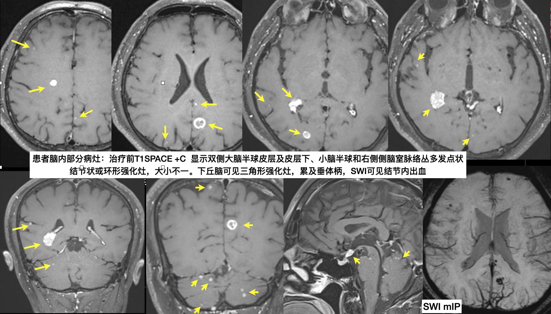 分享一个肺癌脑转移病例