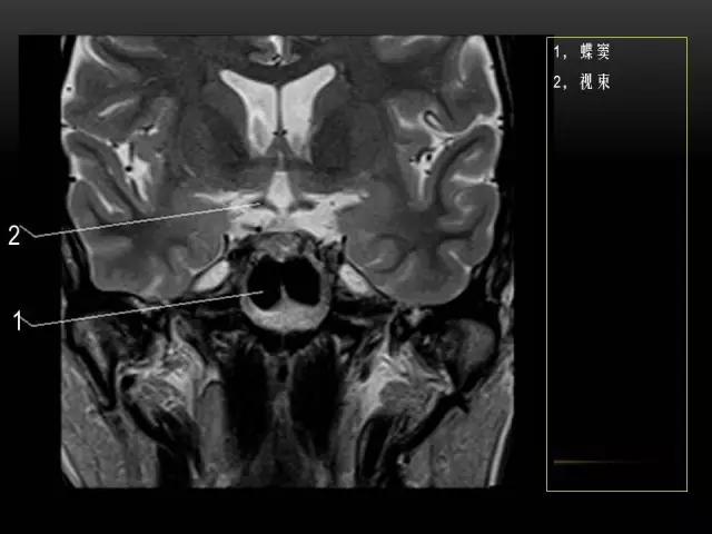 鼻腔鼻窦及颅底ct影像解剖,鼻窦解剖mri