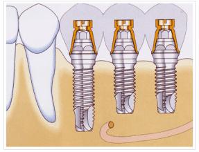 牙医解说蛀牙的危害,医师谈种植牙的手术与维护