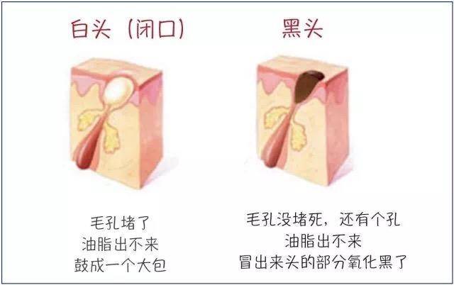 去黑头攻略：被黑头耽误的鼻子是该处理一下了