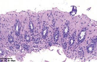 炎症性肠病要活检吗,炎症性肠病常见的病理改变有哪些