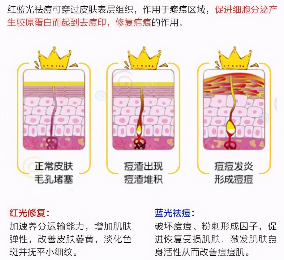医美祛痘治疗有几种？怎么选择？超全科普告别痘肌