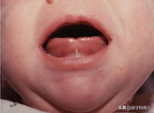 孩子不会说话姥姥说没剪舌根,孩子不讲话剪舌根