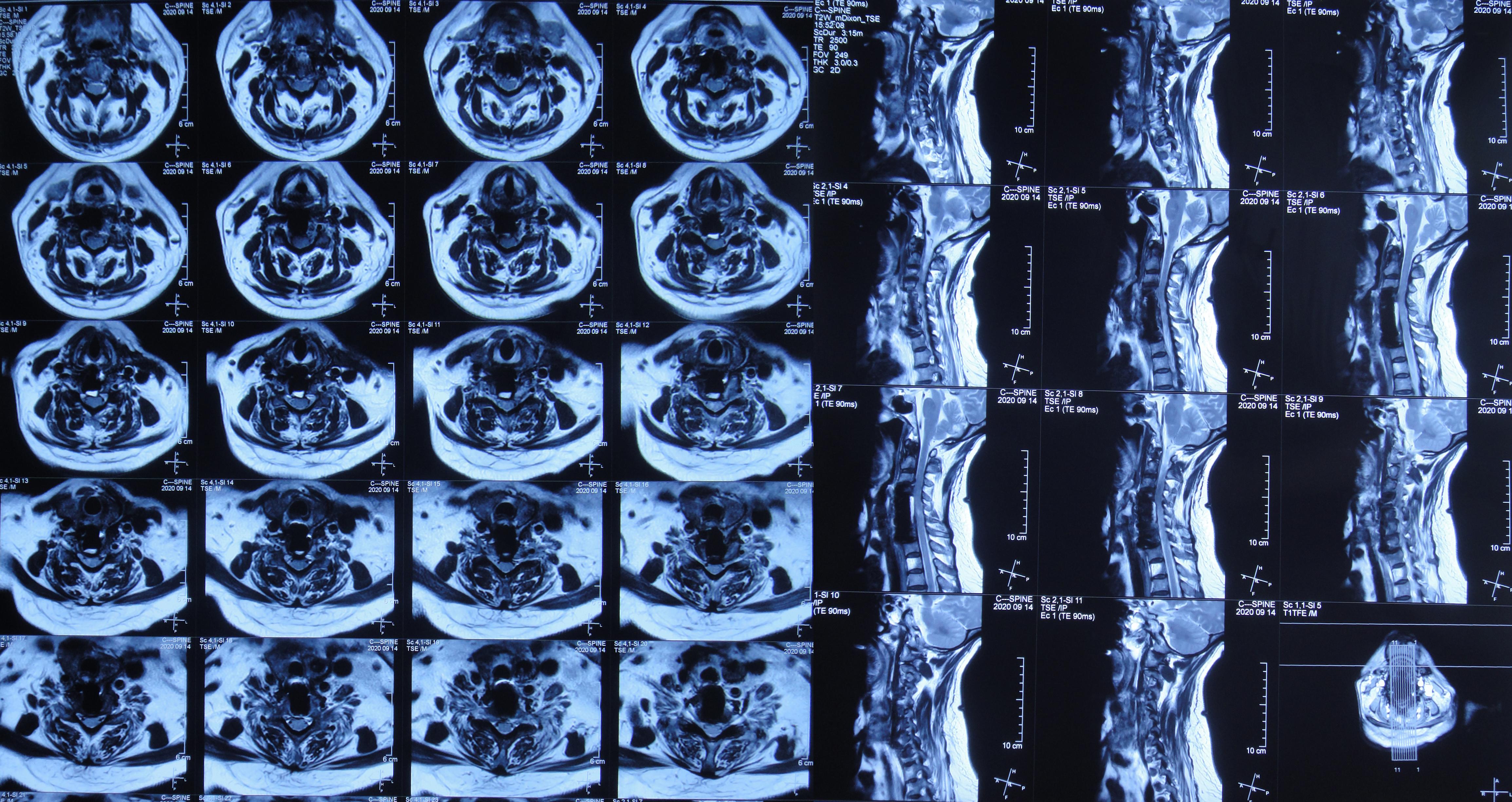 颈椎术后脑脊液漏取什么体位,脊髓型颈椎病手术后植骨愈合时间