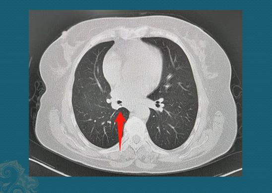 31岁肺癌自愈案例,三十岁肺癌晚期