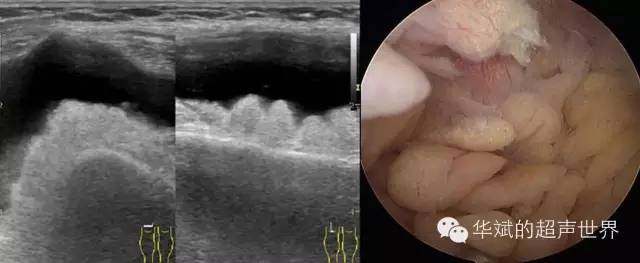 纤维脂肪瘤属于什么类型的疾病,特殊类型脂肪瘤