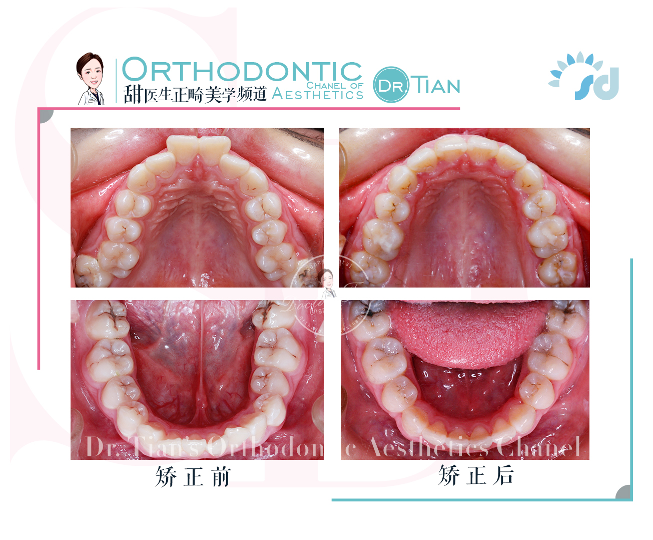 成年人第二磨牙锁合还能矫正吗,西安哪家医院牙齿深覆合矫正好