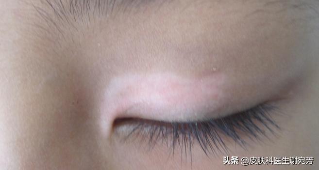 花斑癣白斑和白癜风白斑的区别,长了白斑能自愈是白癜风吗