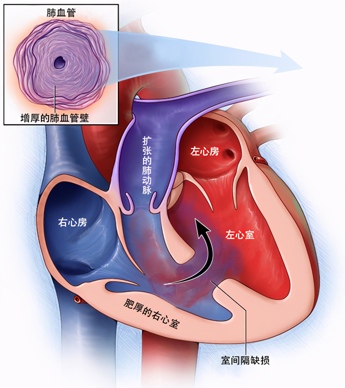 艾森曼格综合征名词解释,艾森曼格综合征症状