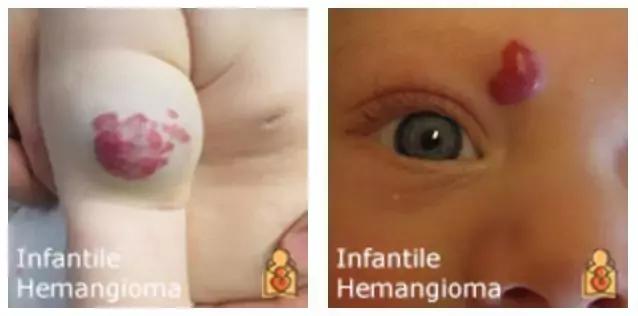 为什么宝宝出生屁股会有青胎记,宝宝出生屁股上有淤青是什么原因