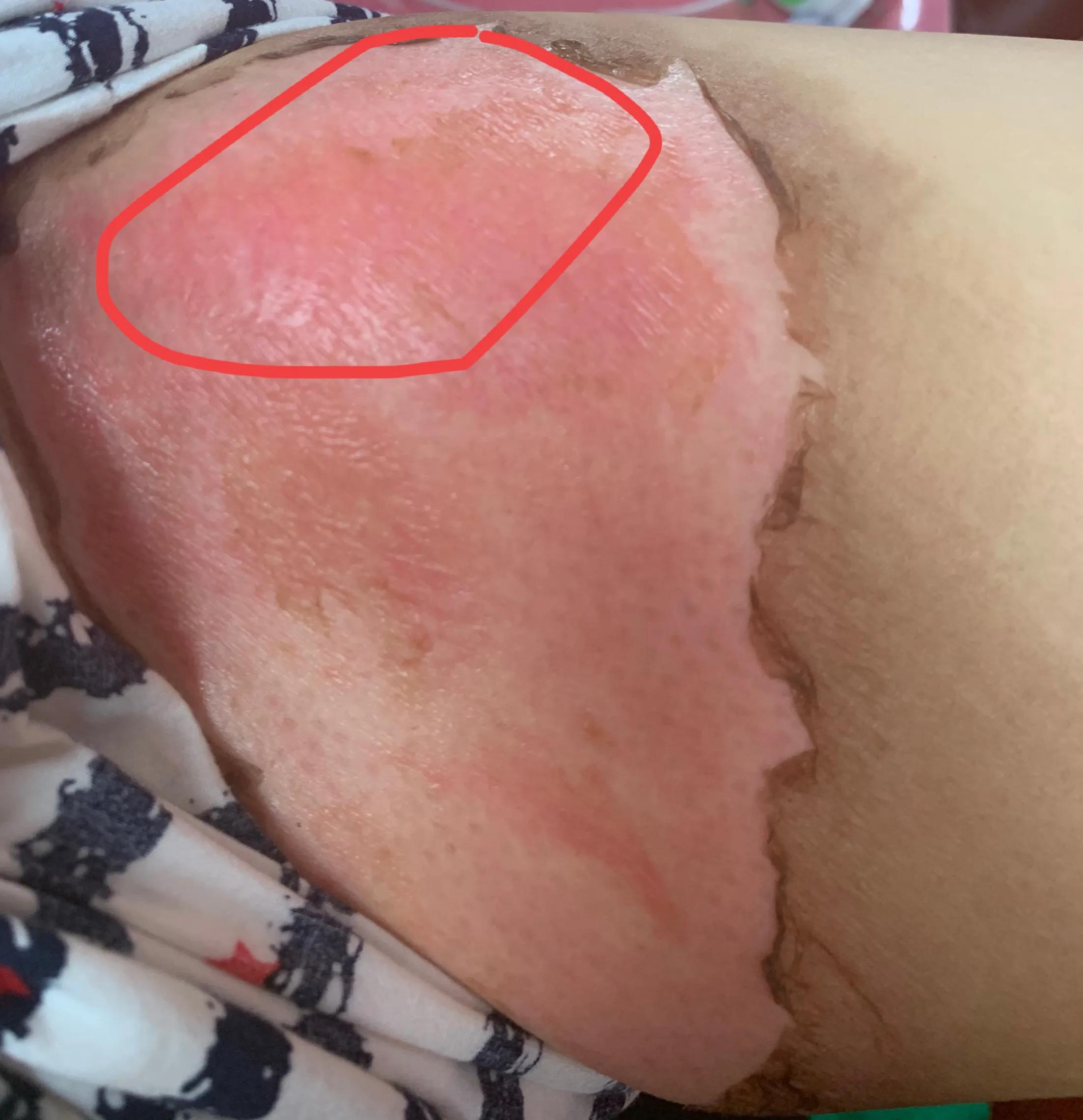 浅二度烫伤14天恢复图片,宝宝浅二度烫伤多久能恢复正常