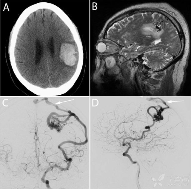 通宵打麻将突发脑出血,打麻将引起脑出血是什么原因