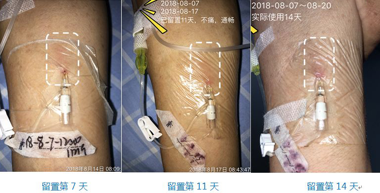 静脉留置针的护理论文,静脉留置针的操作及维护课件