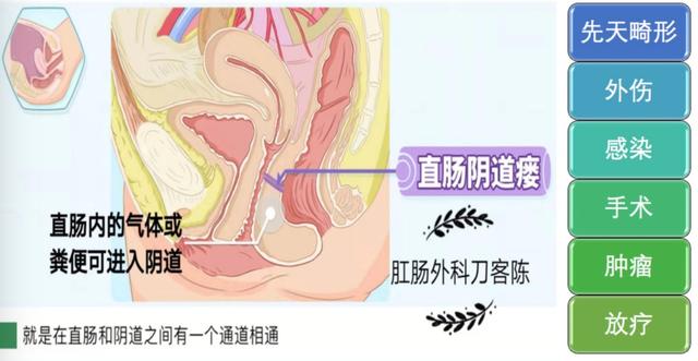直肠阴道瘘是怎么回事？分哪几类？
