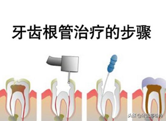 根管治疗不彻底后又蛀牙,根管治疗修复蛀牙