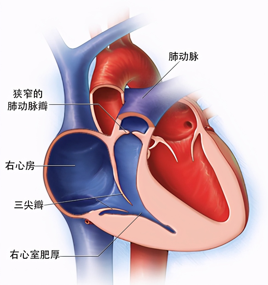 肺动脉瓣狭窄介入手术会痊愈吗,肺动脉瓣狭窄球囊扩张术