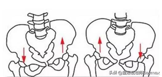 骨盆前倾脊柱侧弯高低肩如何调整,男士高低肩骨盆前倾体态矫正训练