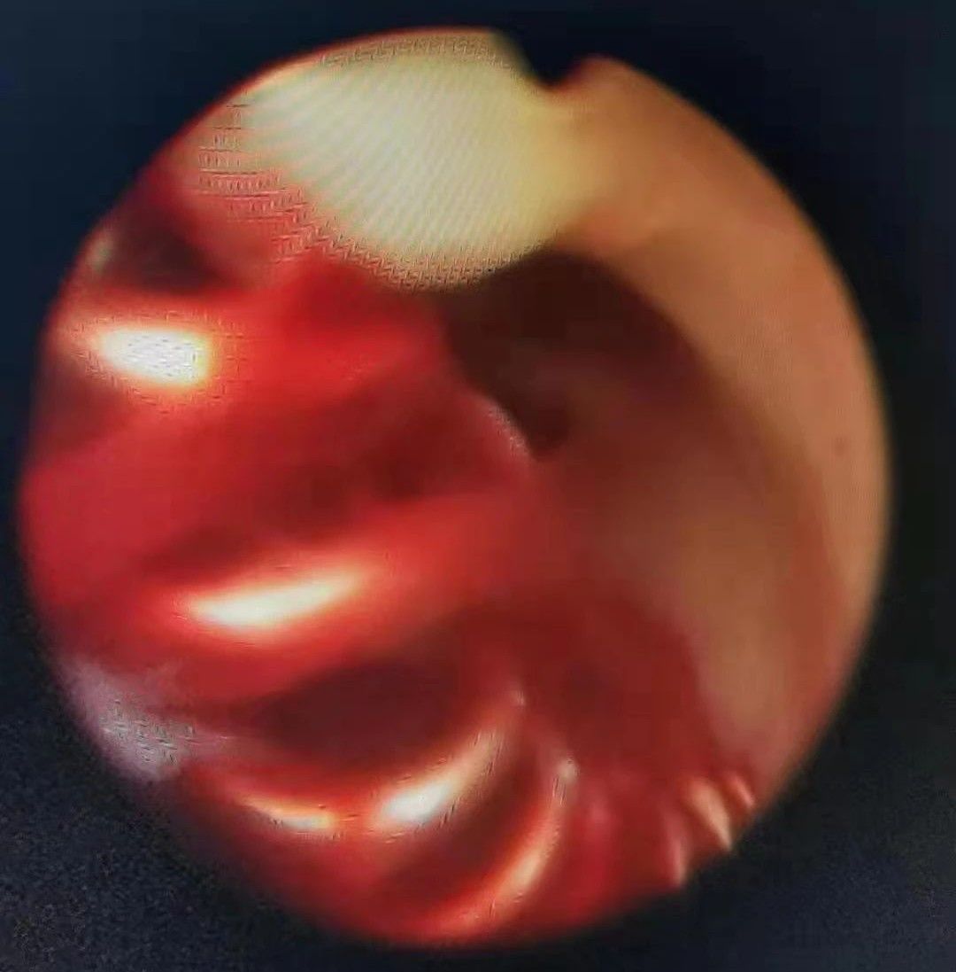 57岁绝经2年又来例假,54岁绝经三年了突然身上来例假了