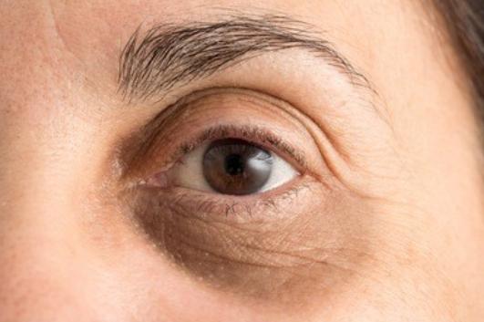 怎么判断你是什么类型的黑眼圈,判断你是什么类型的黑眼圈