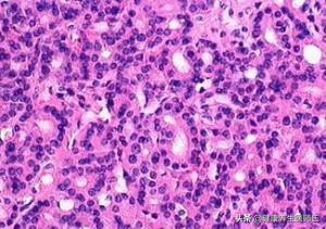 生命缘生殖细胞肿瘤案例,上皮内瘤变是癌变吗