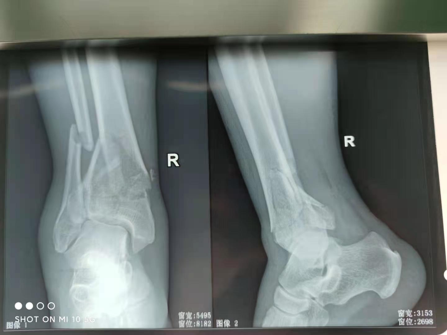 踝关节骨折恢复训练,踝关节骨折几级伤残