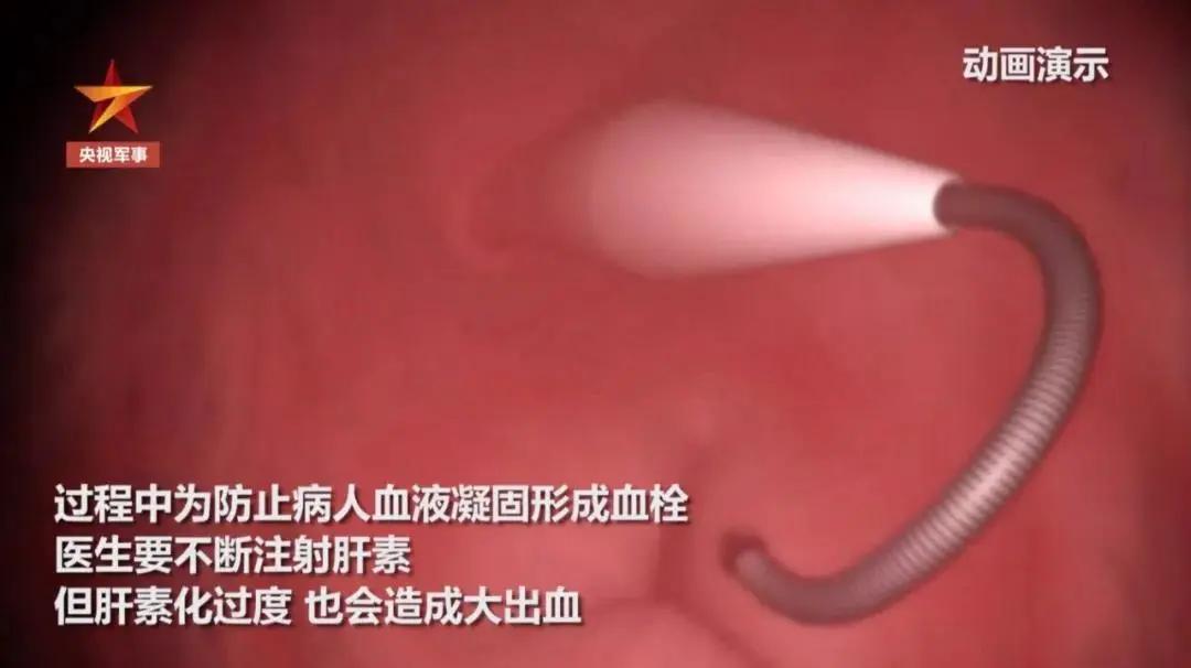 深入“红区”，直击ECMO上机治疗全过程：生死营救5小时，医生跪地抢救…