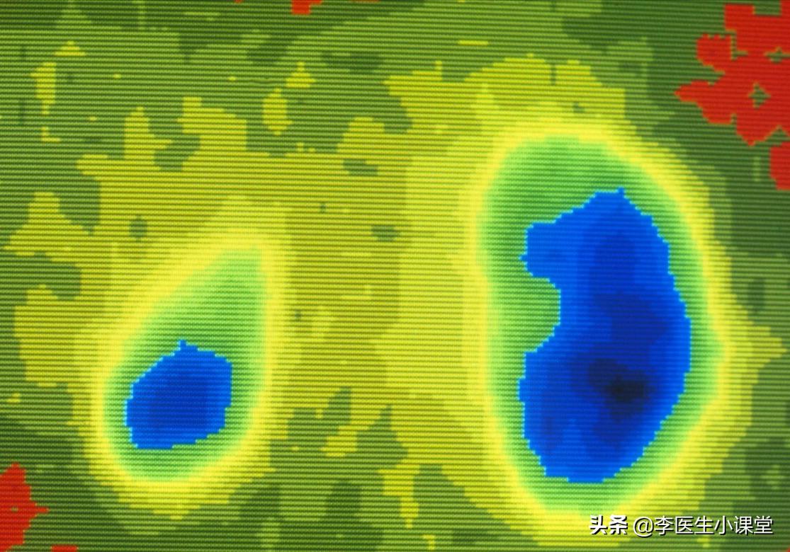 如何保护肾功能避免肾衰竭,肾衰竭怎么做能保护剩下的肾功能