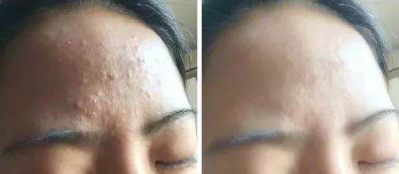 下巴闭口粉刺怎么可以有效的去除,痘痘粉刺闭口怎样护肤