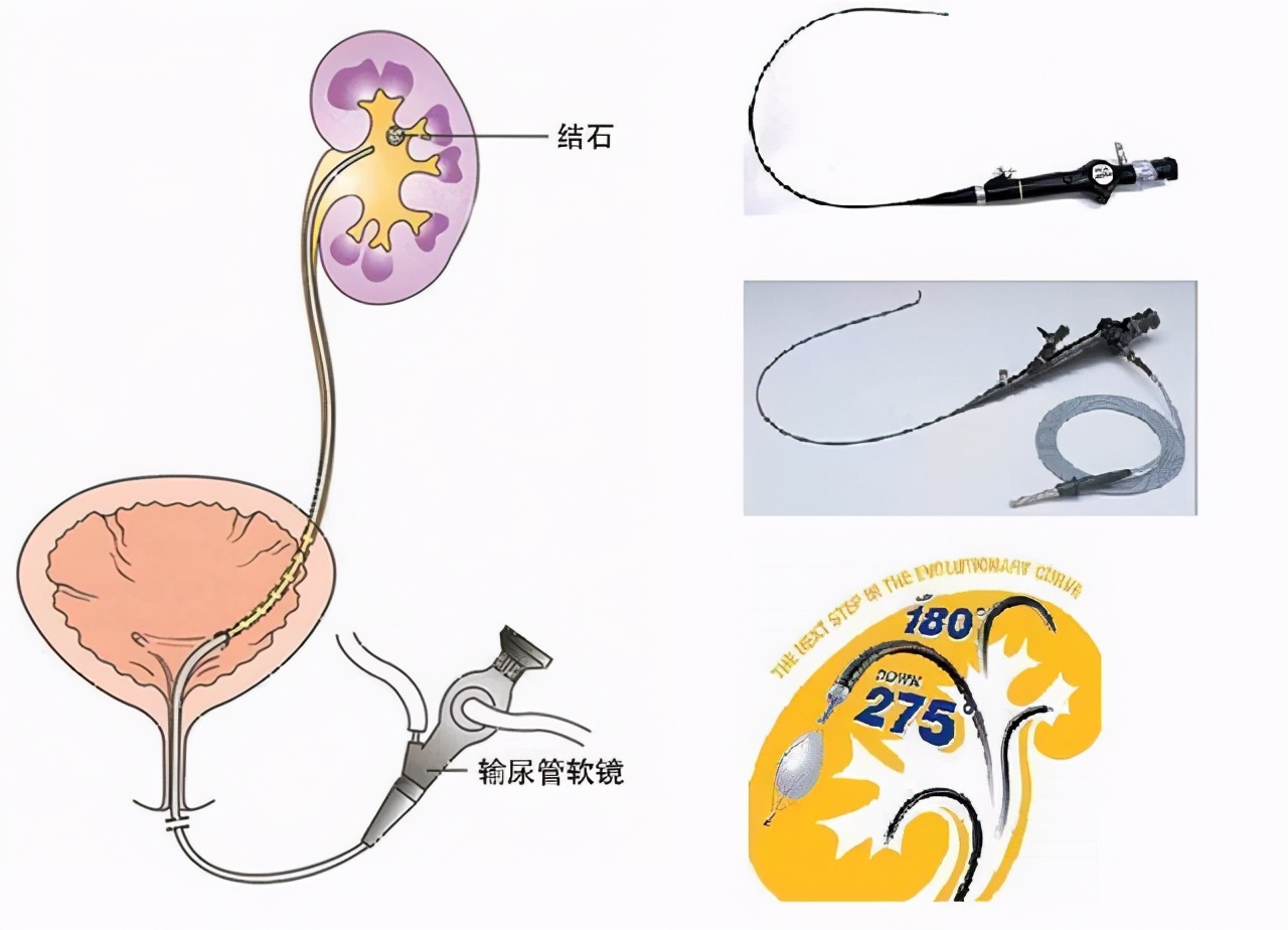 体检查出有肾结石要注意什么,查出有肾结石要注意什么