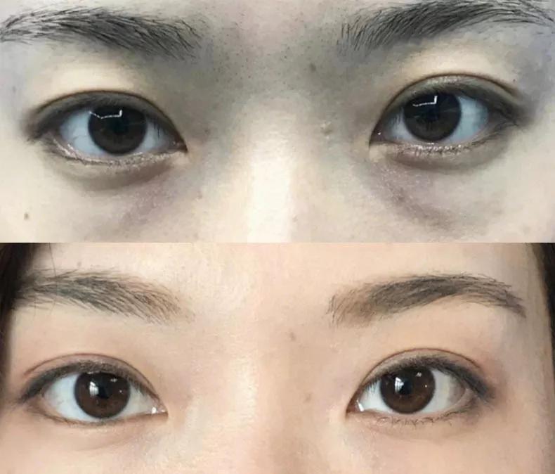 治眼袋三个小妙招快速去眼袋,上眼袋大最简单的去眼袋的方法