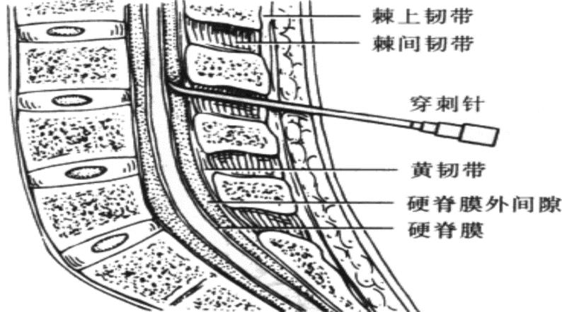 半身麻醉后头痛,麻醉后疼痛处理方案